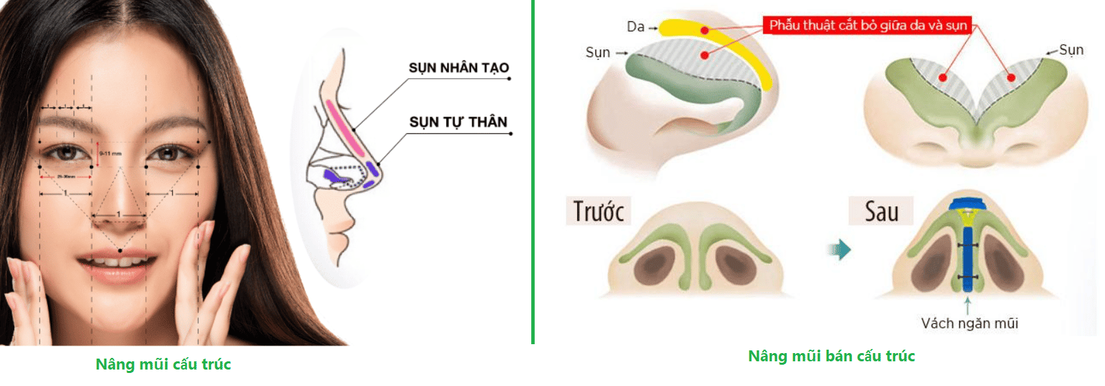 So sánh nâng mũi cấu trúc và bán cấu trúc
