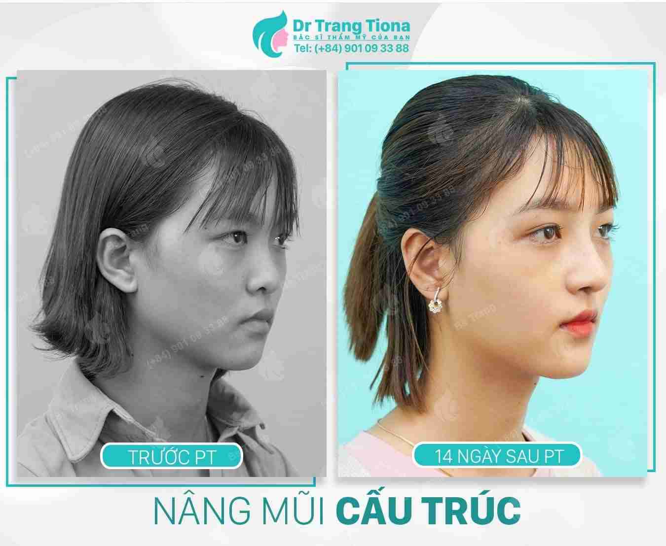 Sống mũi thấp nên nâng mũi bằng sụn sườn hay sụn nhân tạo?