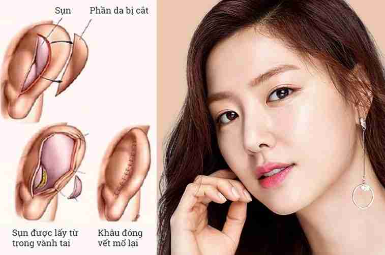 Có được sử dụng sụn tai của người thân để nâng mũi không?