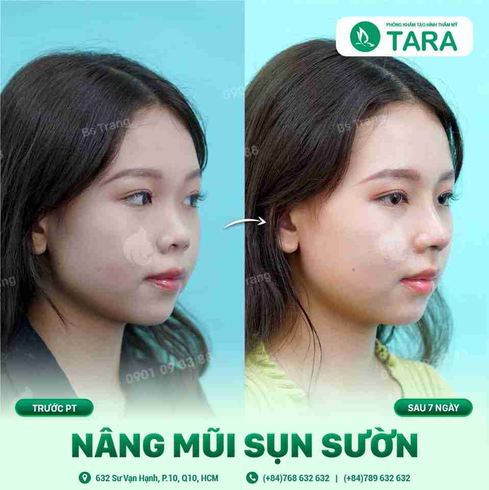 7 sự thật ít biết về nâng mũi sụn sườn