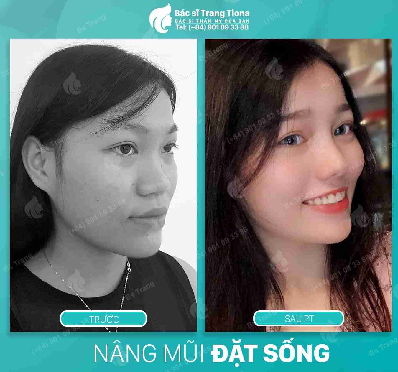 Sự thật về 5 tướng mũi giàu giúp bạn thành công?