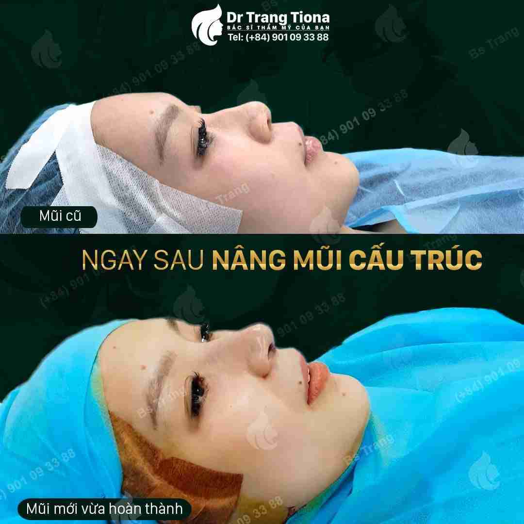 Sự thật về nâng mũi có thay đổi vận mệnh?