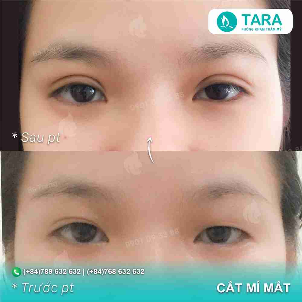 Sự thật việc cắt mí mắt để được vĩnh viễn