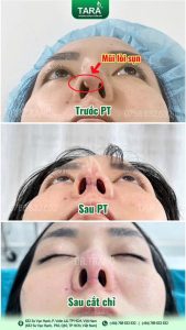 Sửa mũi có đau hơn nâng mũi không và giải pháp “thần kỳ” từ kỹ thuật siêu phẫu