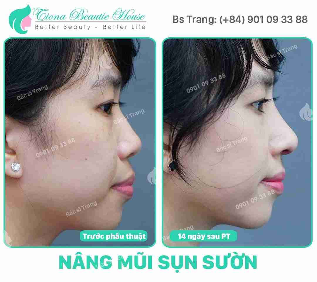 Sửa mũi có đau không? và “GÂY TÊ ĐA TẦNG” by Dr Trang TARA