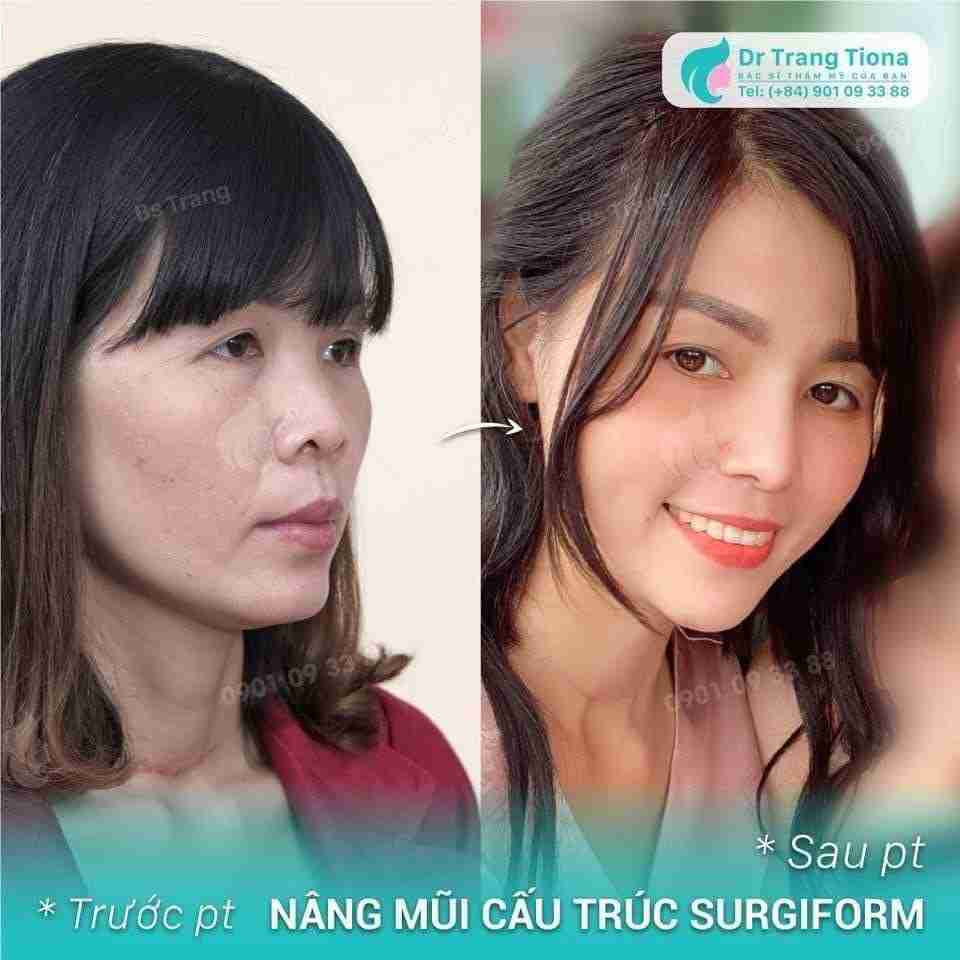 Sửa mũi có đau không? và “GÂY TÊ ĐA TẦNG” by Dr Trang TARA