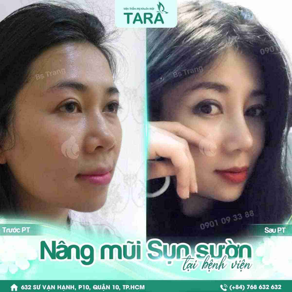 Sửa mũi gãy bằng phương pháp nào? Giá bao nhiêu?