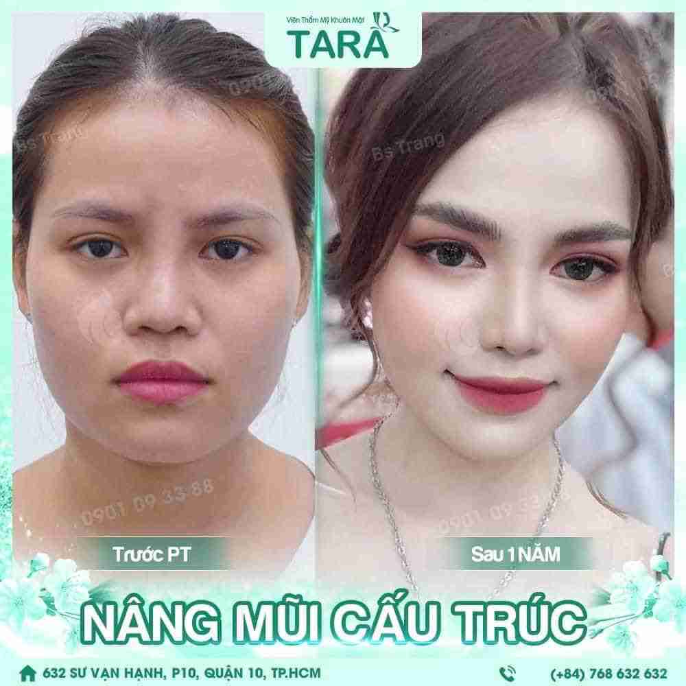 Sửa mũi gãy bằng phương pháp nào? Giá bao nhiêu?