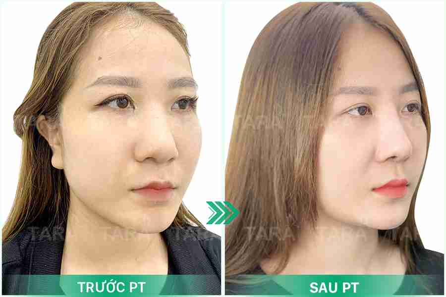Sửa mũi hỏng nhiều lần có nguy hiểm không?