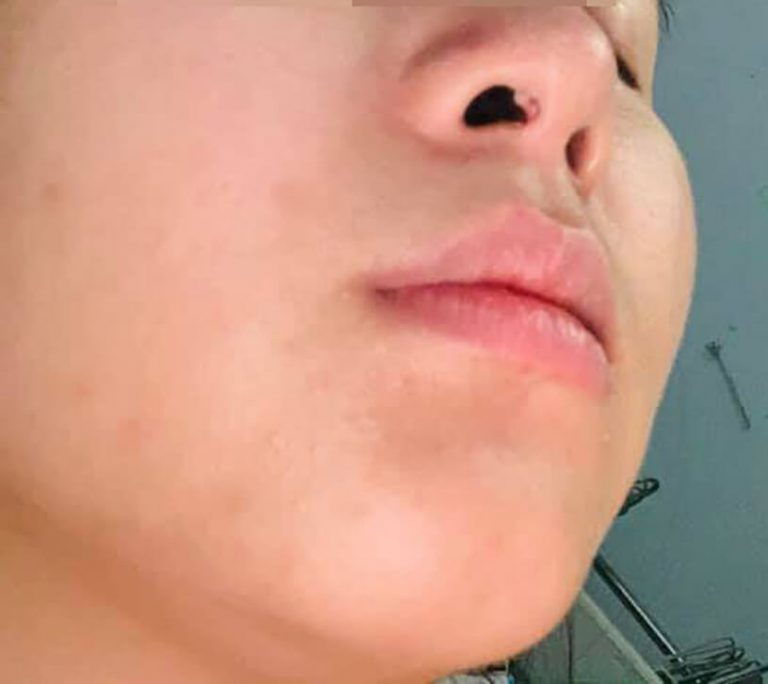 Tìm kiếm giải pháp sửa mũi hỏng sau phẫu thuật đúng cách