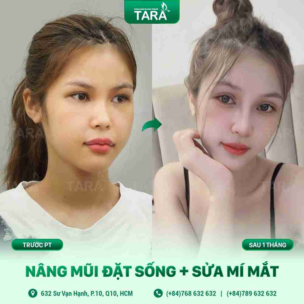 Sửa Mũi Hỏng Sau Phẫu Thuật