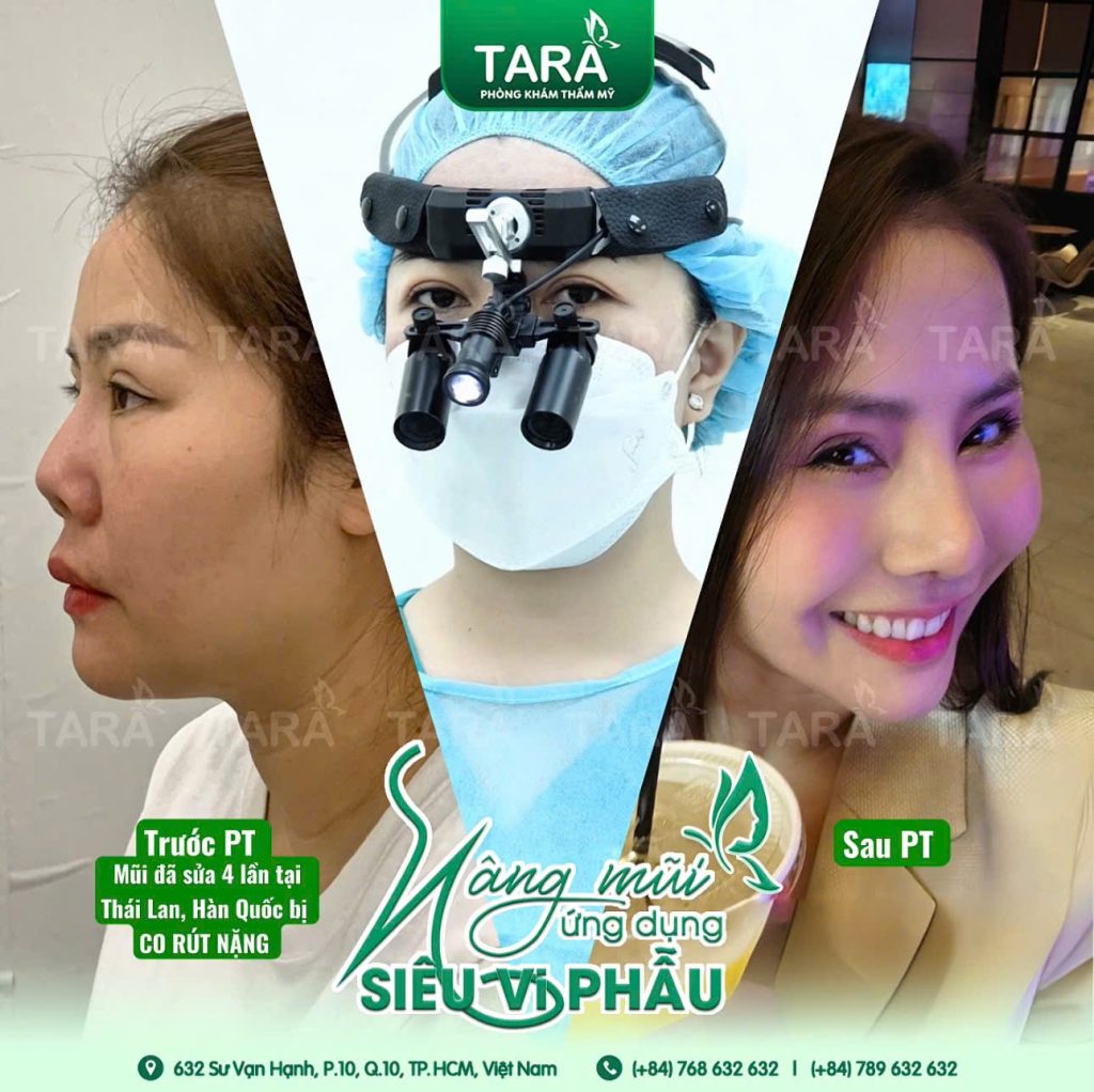 Sửa mũi hỏng bằng kỹ thuật siêu vi phẫu: Giải pháp tái tạo mũi tự nhiên & an toàn