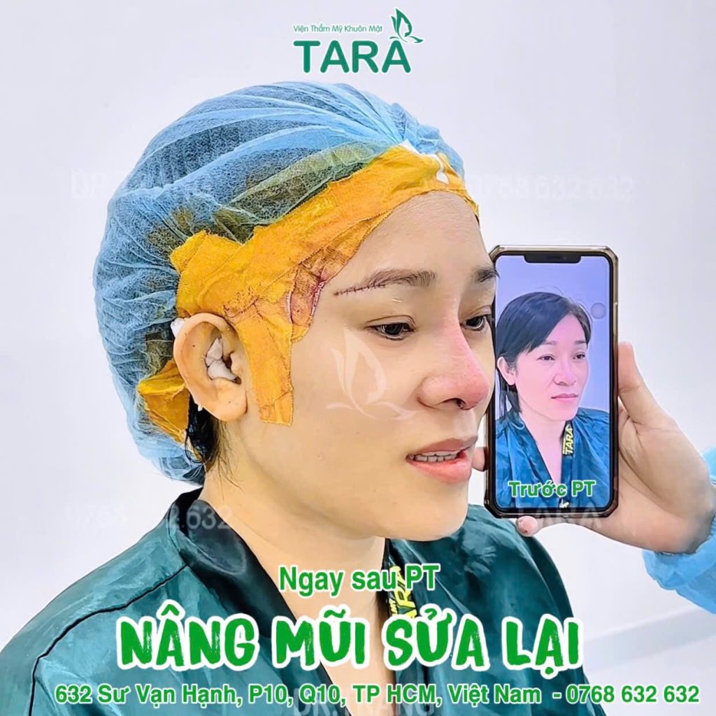 Kỹ thuật siêu vi phẫu: đỉnh cao cho những ca sửa mũi hỏng phức tạp