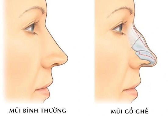 Sửa sóng mũi gồ như thế nào để có dáng mũi đẹp?