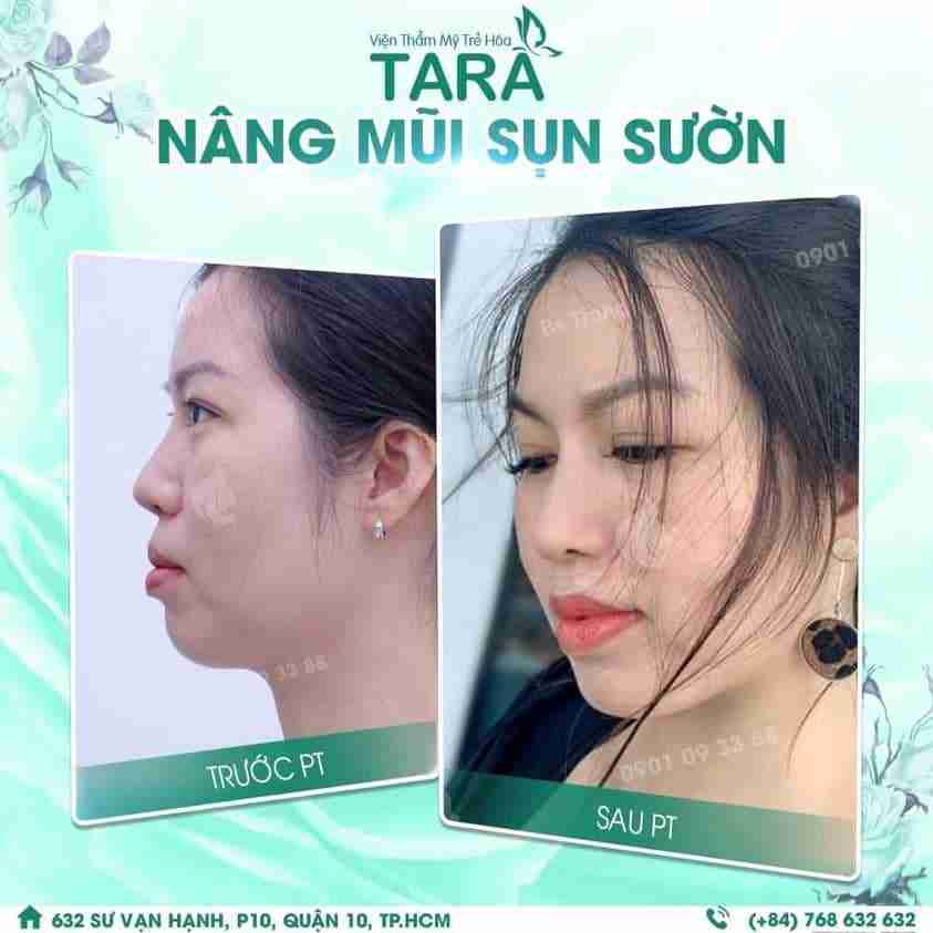 Sụn sườn được lấy từ đâu để nâng mũi?