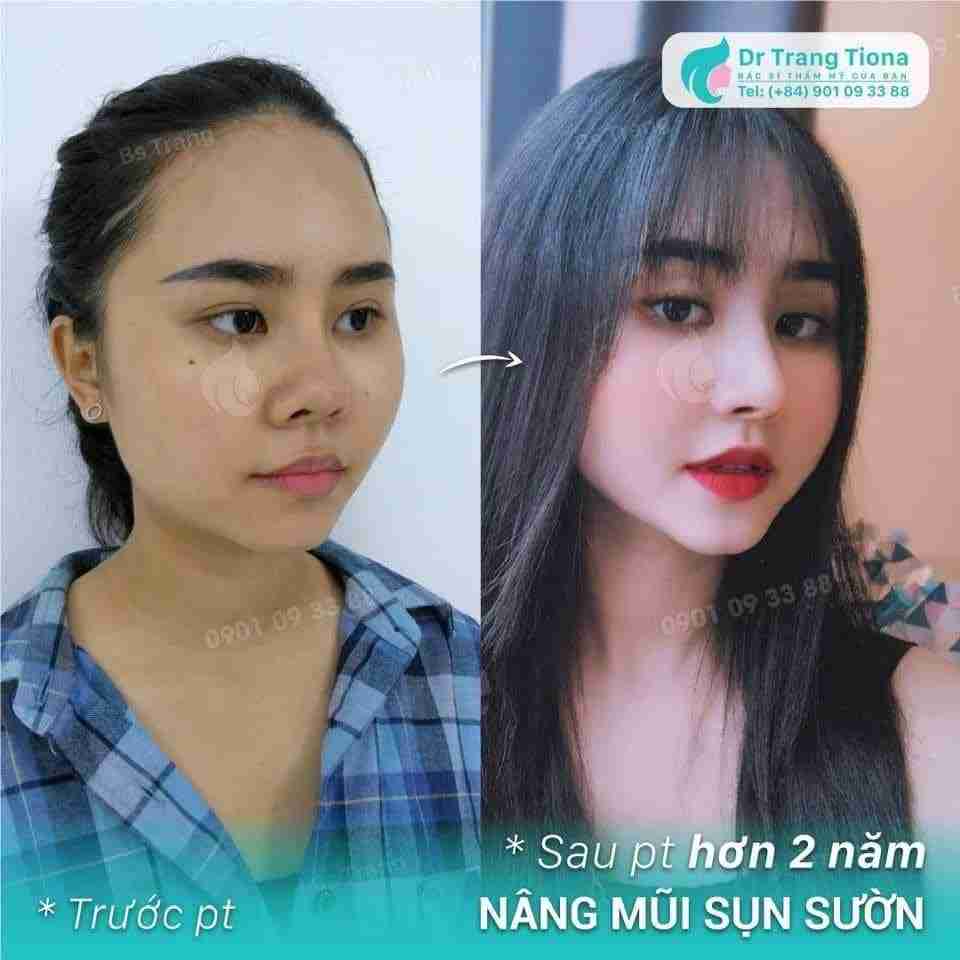 Sụn sườn được lấy từ đâu để nâng mũi?