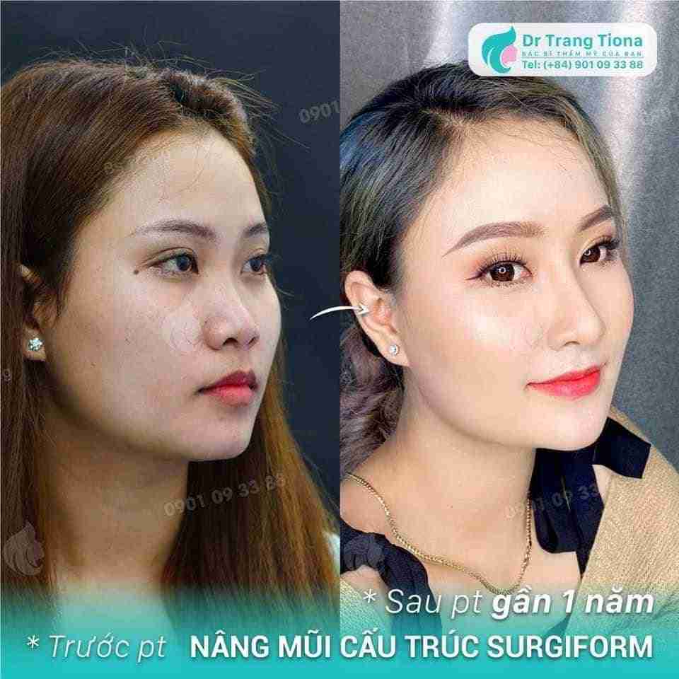 Sụn sườn được lấy từ đâu để nâng mũi?