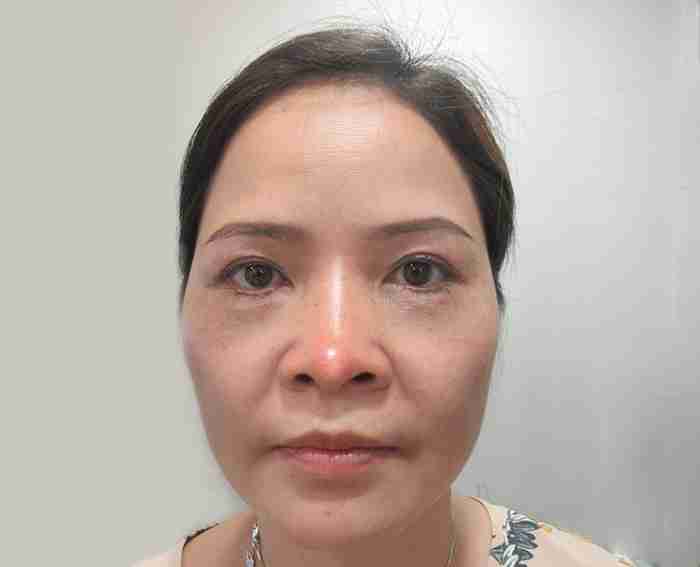 Tại sao đầu mũi bị bóng đỏ sau nâng mũi? Có nguy hiểm không?