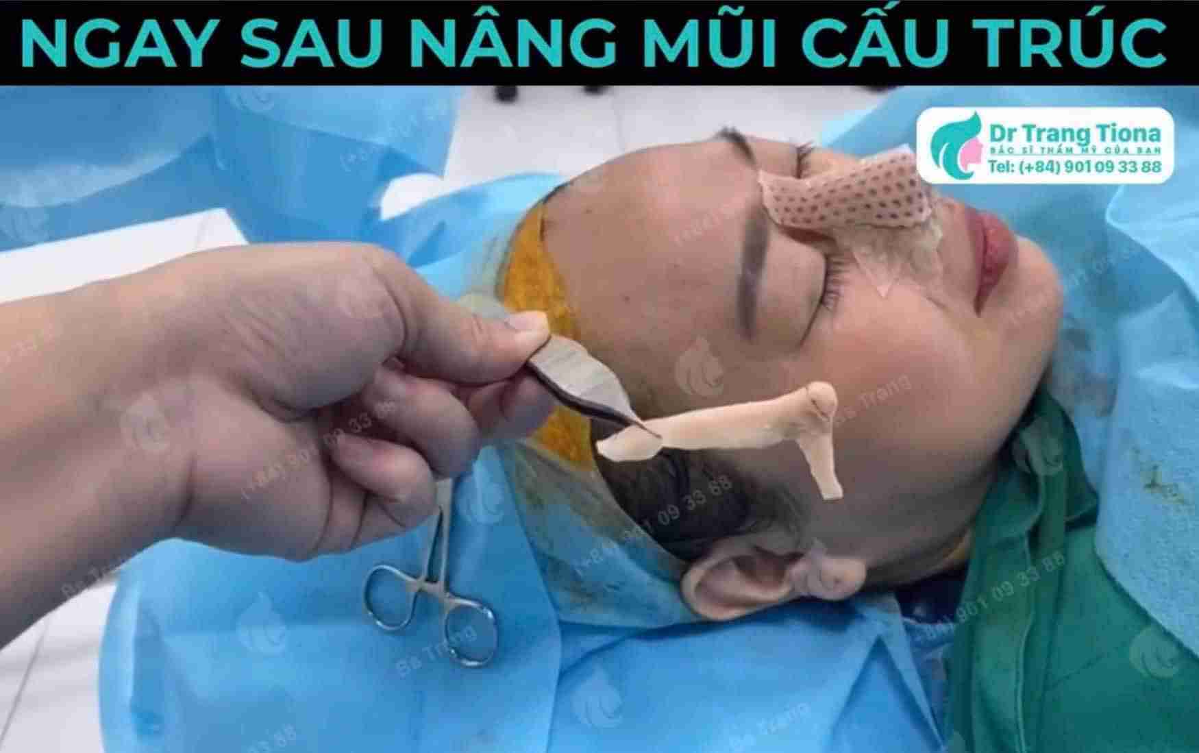 Tại sao phải dùng nẹp định hình khi phẫu thuật nâng mũi?