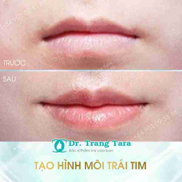 PHẪU THUẬT TẠO HÌNH MÔI TRÁI TIM – GIẢI PHÁP MỚI CHO ĐÔI MÔI QUYẾN RŨ