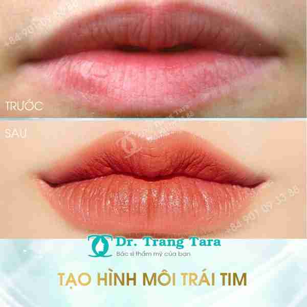 PHẪU THUẬT TẠO HÌNH MÔI TRÁI TIM – GIẢI PHÁP MỚI CHO ĐÔI MÔI QUYẾN RŨ