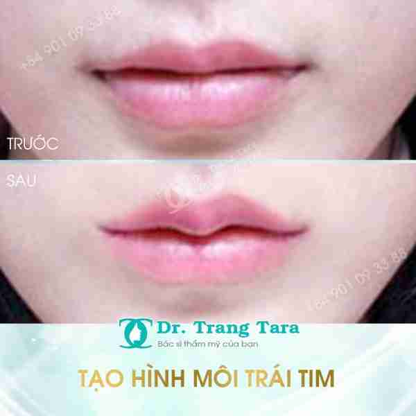 PHẪU THUẬT TẠO HÌNH MÔI TRÁI TIM – GIẢI PHÁP MỚI CHO ĐÔI MÔI QUYẾN RŨ