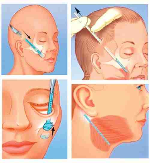 Tất tần tật về phương pháp căng da nội soi