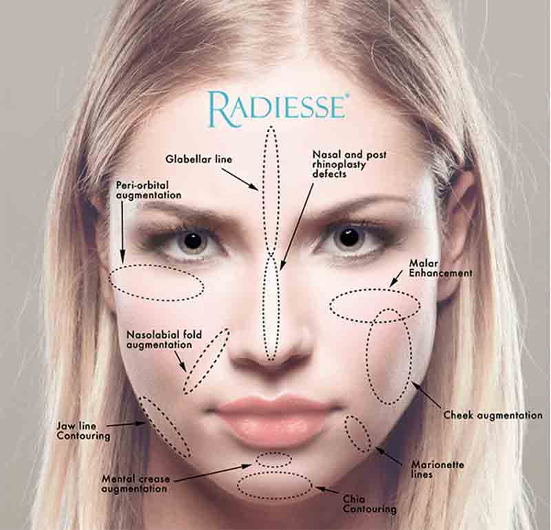 Tất tần tật về phương pháp làm đầy da bằng Radiesse