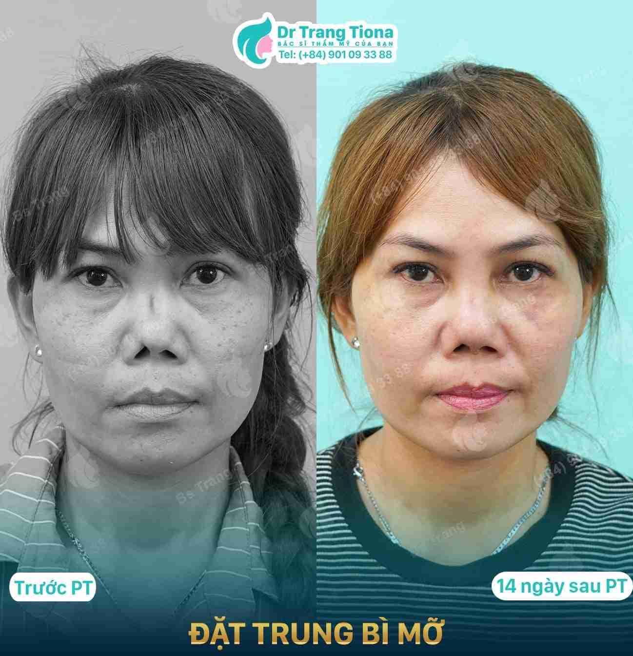 Tháo sụn mũi đã nâng có đau không? Lưu ý khi thực hiện