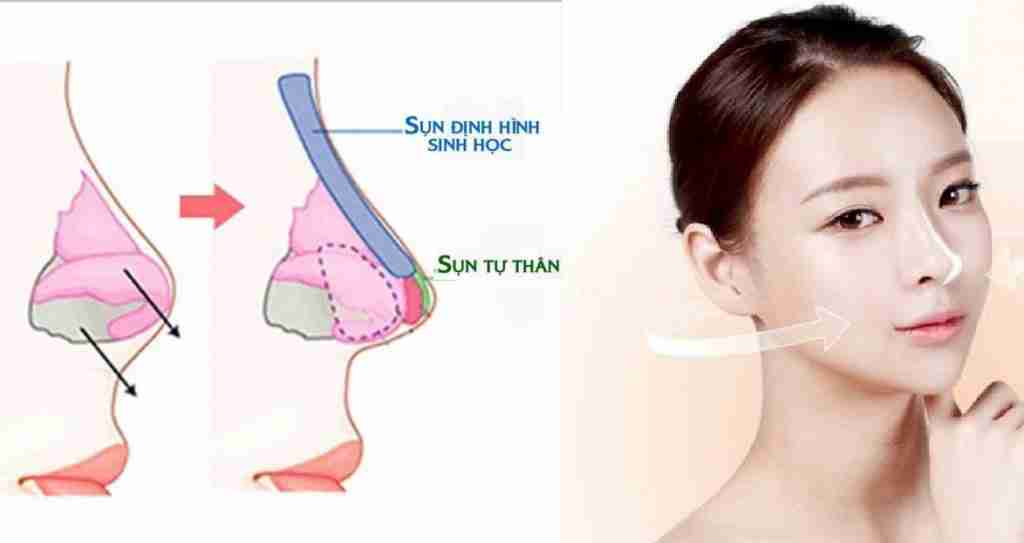 Tháo sụn mũi xong mũi có trở lại bình thường không?