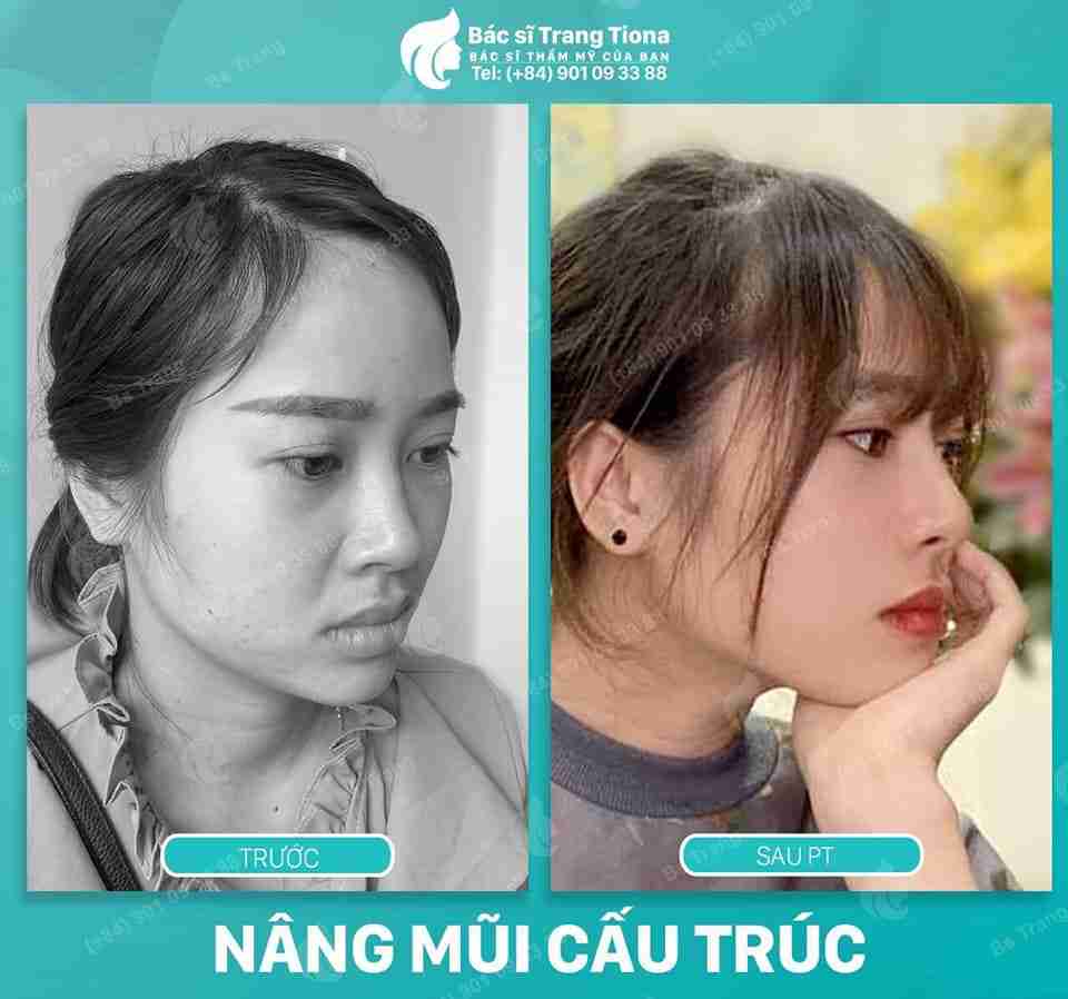 Giải đáp từ A-Z thế nào là quy trình nâng mũi đạt chuẩn