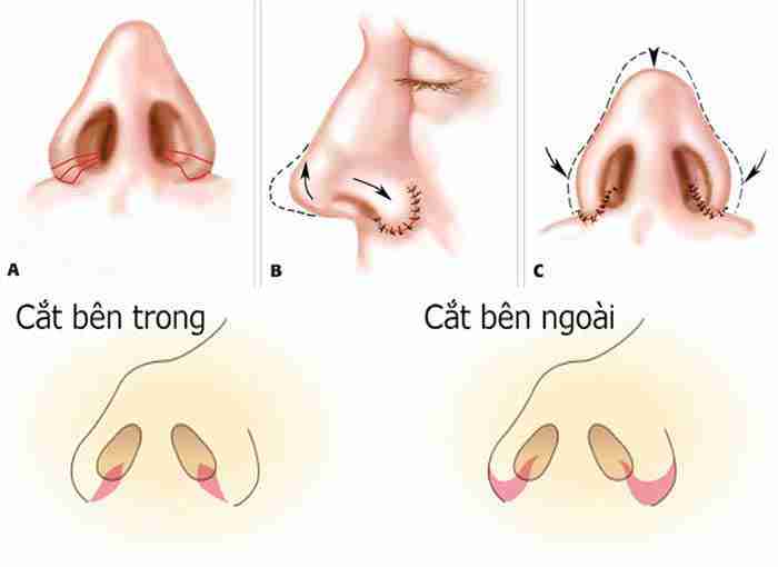 Bác sĩ giải đáp: Thu gọn cánh mũi có bị sưng đau không?
