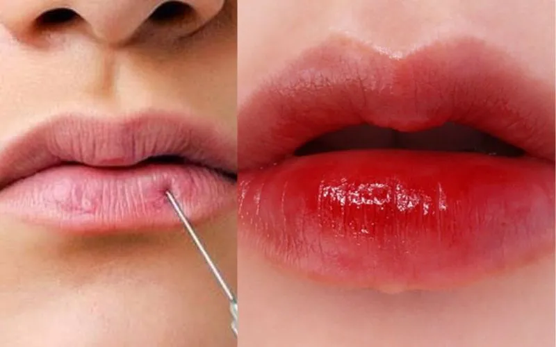 Tiêm filler môi có nên không? Giá bao nhiêu?