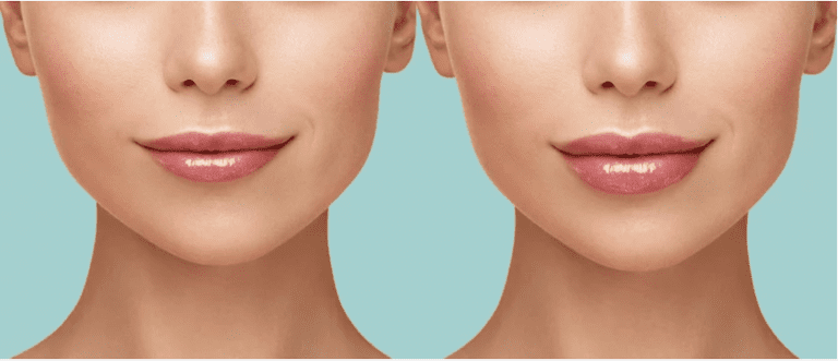 Bác sĩ giải đáp: Tiêm filler môi để được bao lâu?