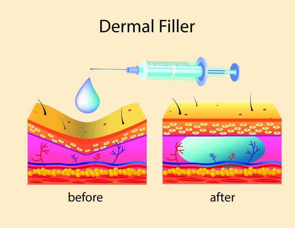 Tiêm filler mũi và những sự thật bạn cần biết rõ