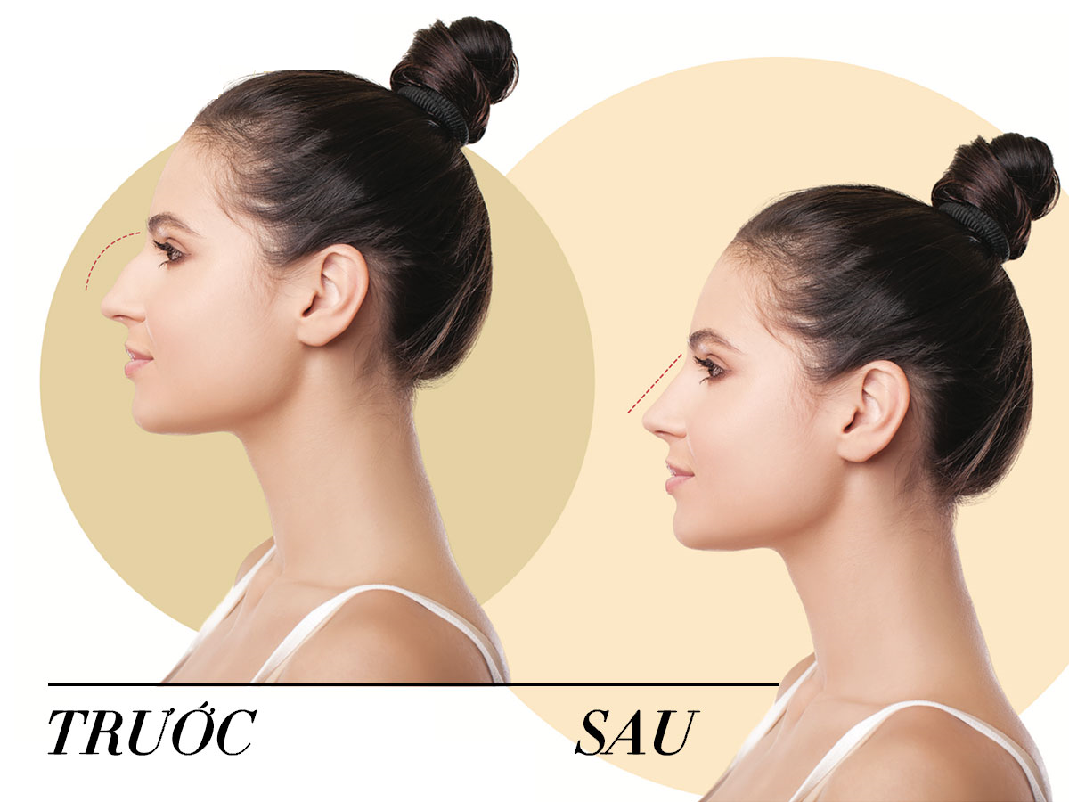 Tiêm filler mũi và những sự thật bạn cần biết rõ