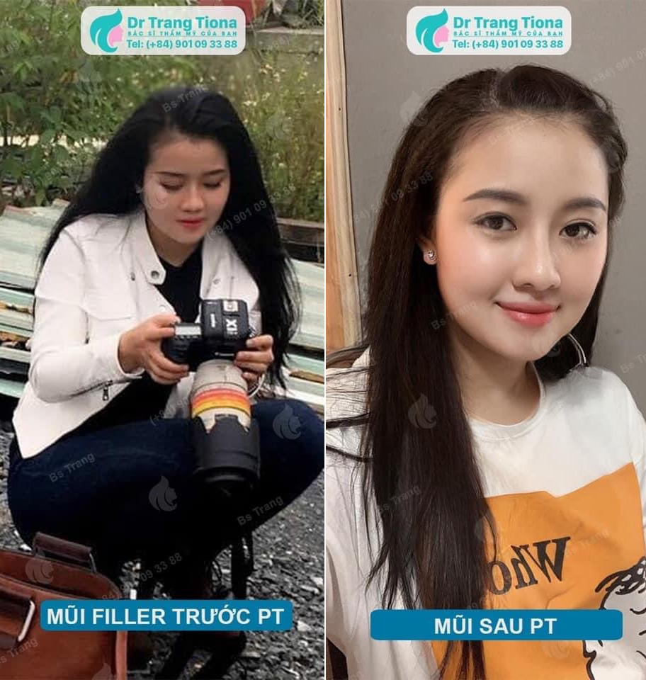 Tiêm filler mũi và những sự thật bạn cần biết rõ