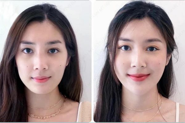 Tiêm filler tạo hình khuôn mặt có nguy hiểm về sau không?