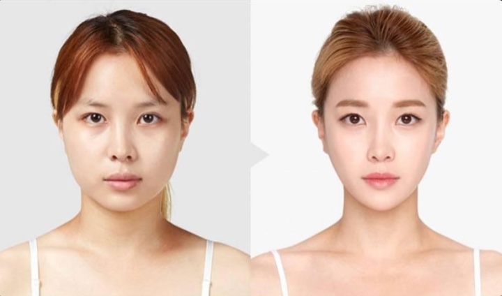 Tiêm Radiesse cằm: Khắc phục khuyết điểm cằm hoàn hảo