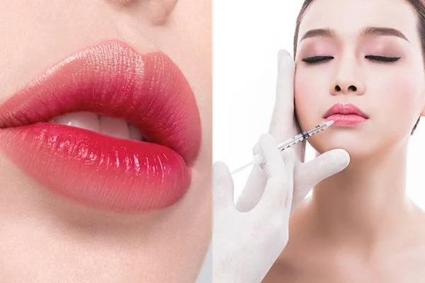 Tiêm trẻ hoá tạo hình khuôn mặt là gì?