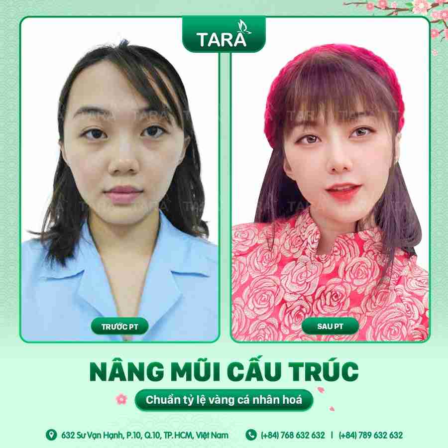 Toàn bộ về phẫu thuật nâng mũi cấu trúc: Phù hợp cho ai?