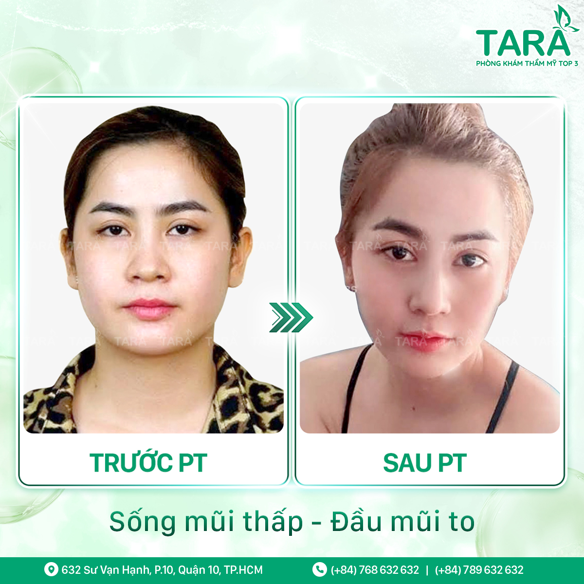 Bác sĩ nâng mũi đẹp uy tín tại TPHCM – Bác sĩ Trang Thẩm mỹ TARA