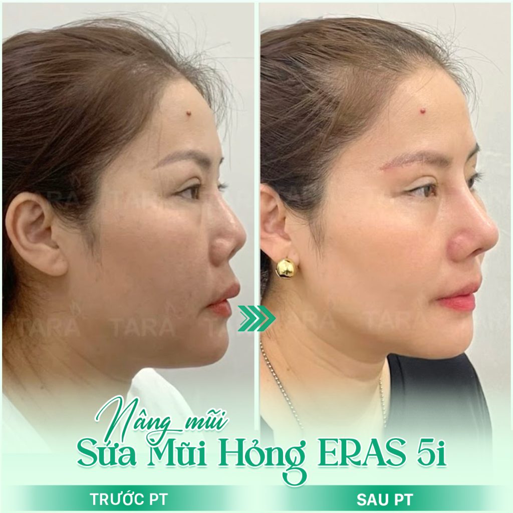 Bác sĩ nâng mũi đẹp uy tín tại TPHCM – Bác sĩ Trang Thẩm mỹ TARA