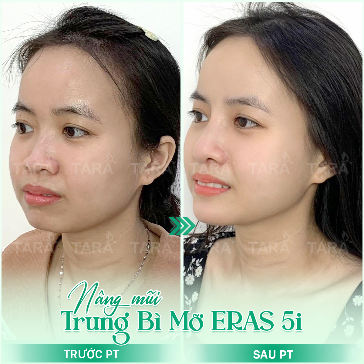 Địa chỉ nâng mũi đẹp uy tín tại TP HCM – Tiến sĩ Bác sĩ Trang Thẩm mỹ TARA – Dr Trang TARA