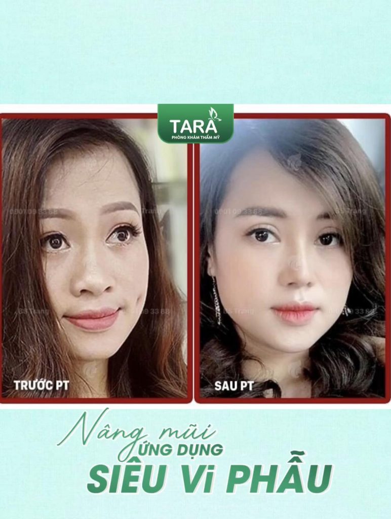Top 6 bí quyết giảm đau sau khi nâng mũi bác sĩ nào cũng khuyên