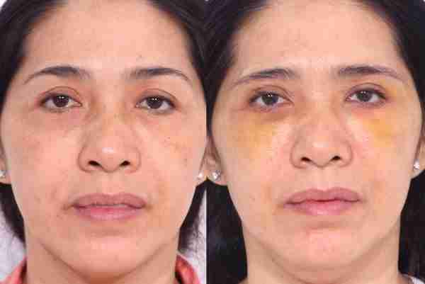 Treo cung chân mày – Giải pháp cho đôi mắt trẻ trung, to tròn