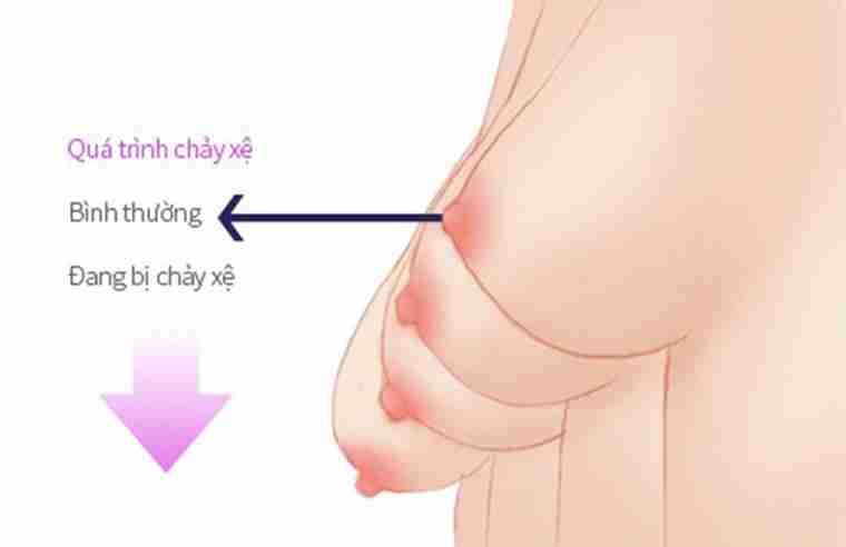 Treo ngực sa trễ là gì – Giải đáp từ bác sĩ phẫu thuật
