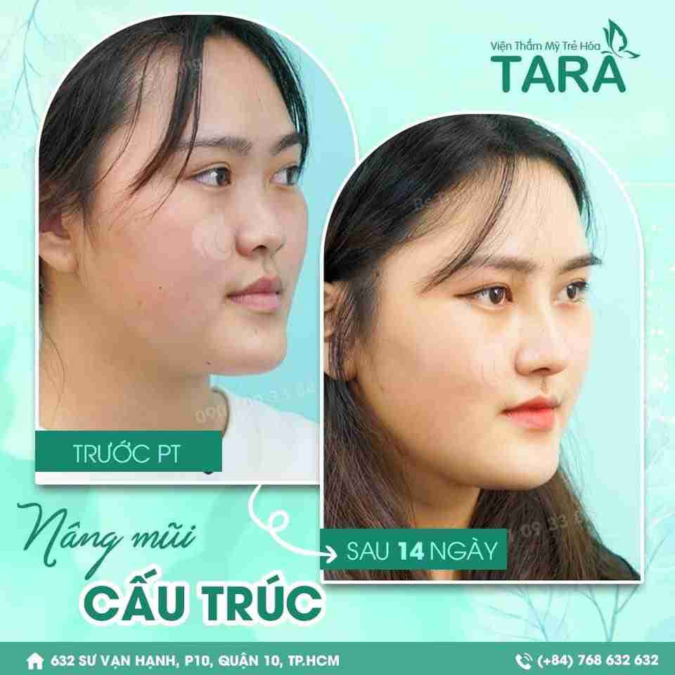 Trước khi nâng mũi có được ăn không? Nên ăn gì?
