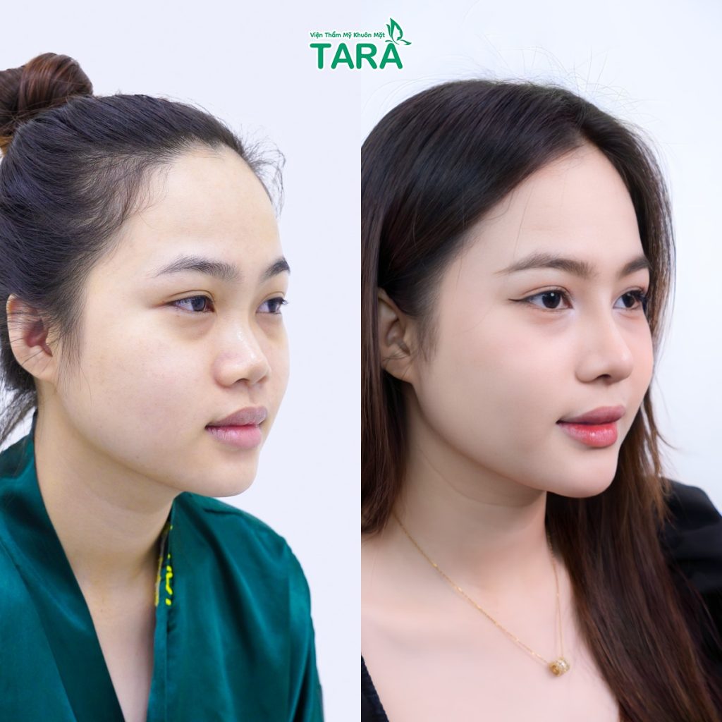 TS.BS Trang: “Không phải cứ nâng mũi cao là đẹp”