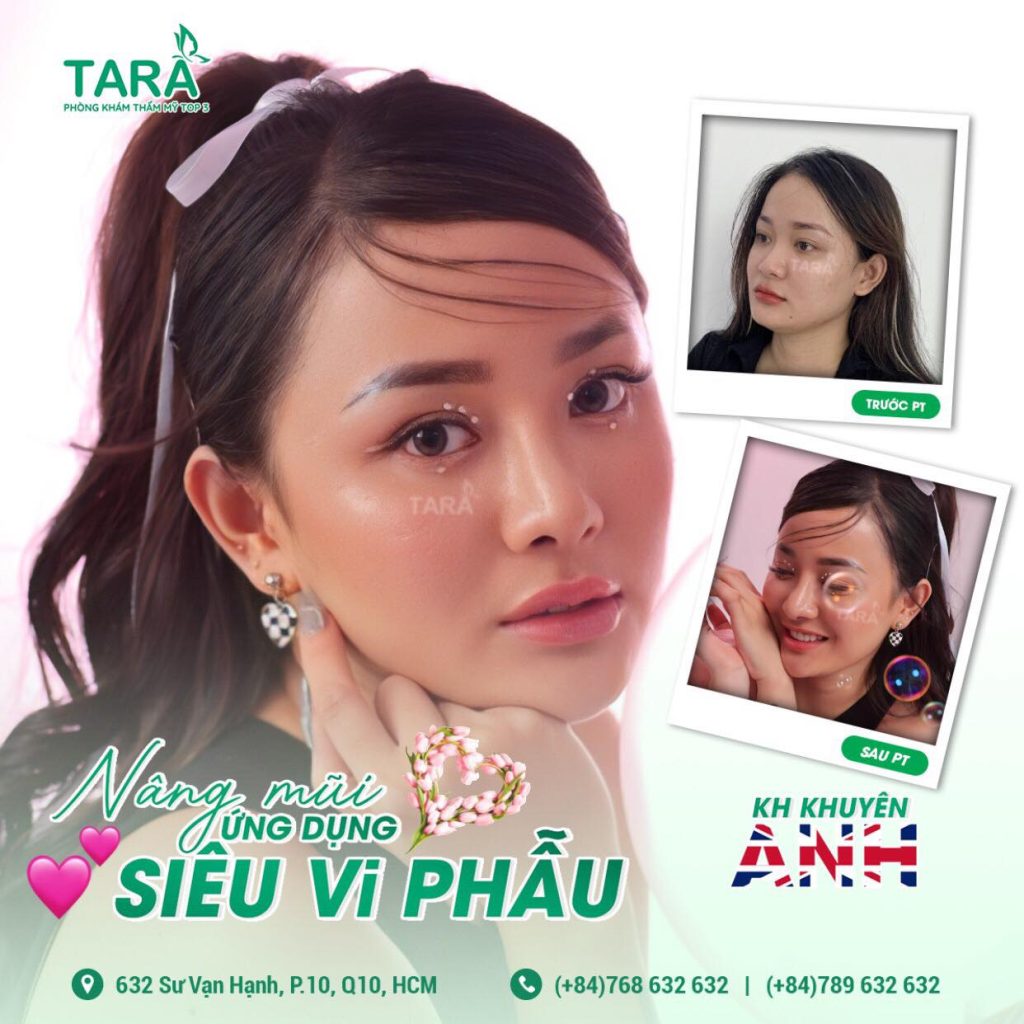 TS.BS Trang: Nâng mũi bóc tách siêu vi phẫu không cần nẹp, 3 ngày vào form